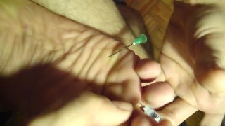 needle on my soles & between toes