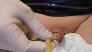 removal 20Fr Catheter