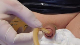 removal 20Fr Catheter
