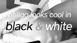 Vitiligo/ Smoke Sesh