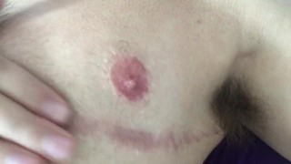 FtM Chest Scar Massage