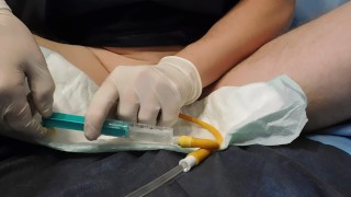 removal 20Fr catheter