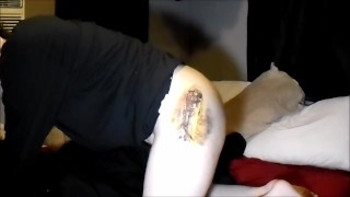 Dr will be mad! Post-Surgery Cum while Still Recovering FTM
