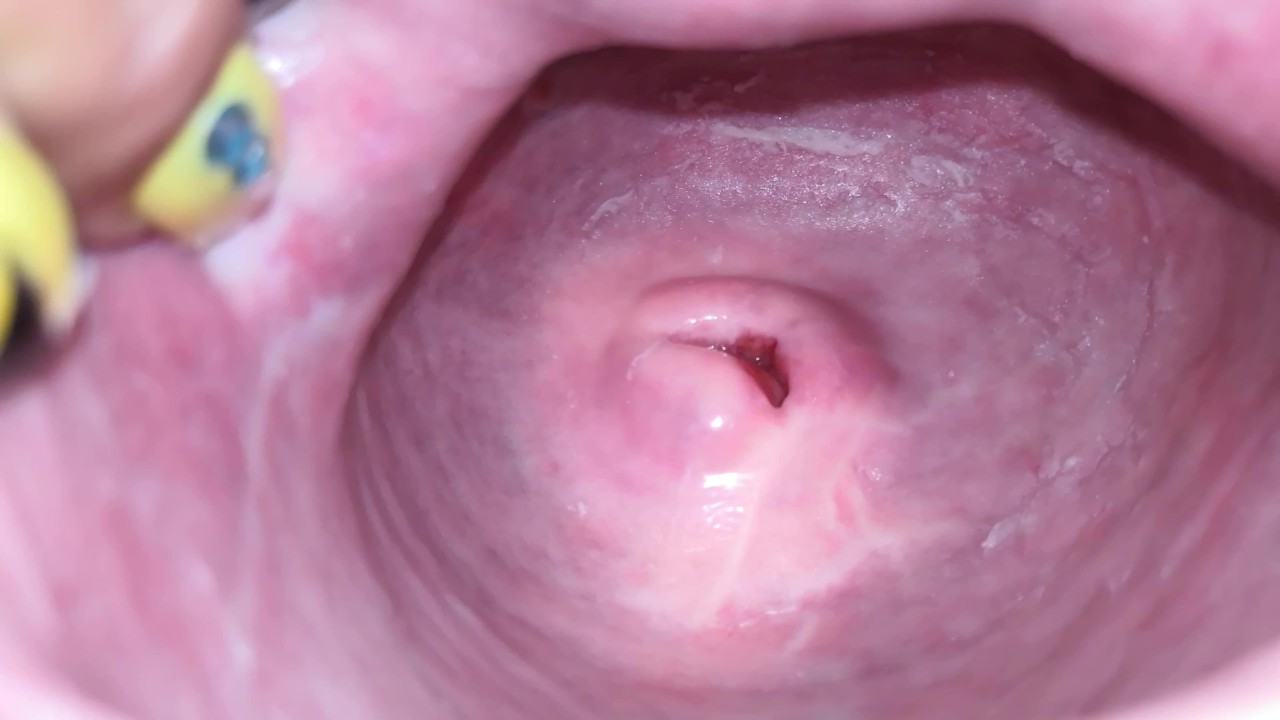 Cervix close up [4k] - Free Porn Videos - YouPorn