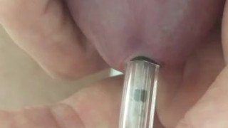 Penetration uretre