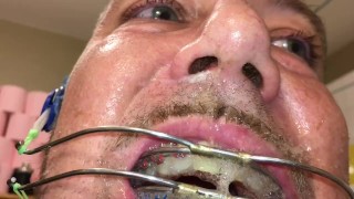 Horny deepthroat full of spit with braces and double headgear