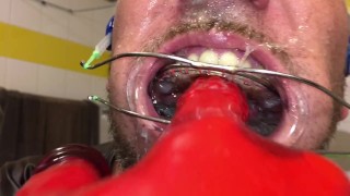 Horny deepthroat full of spit with braces and double headgear
