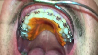 New Braces retainer and Twinblock with headgear for new aventures