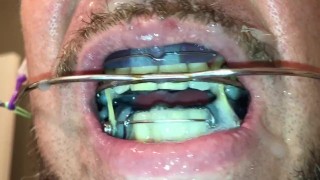 Self facial cumming on braces retainer twinblock with headgear