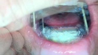 Self facial cumming on braces retainer twinblock with headgear
