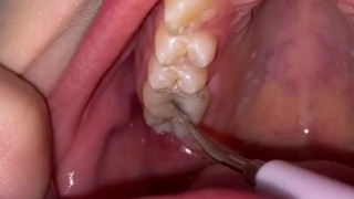 Ultrasonic teeth cleaning. Teeth fetish.