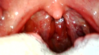 My throat with endoscope