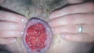 Gay guy plays with his cummy prolapse