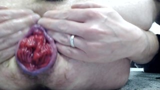 Gay prolapse training