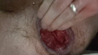 Fisting My Prolapse