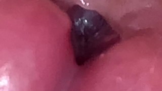 Urethral Examination 