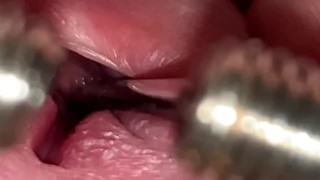 URETHRAL SOUNDING