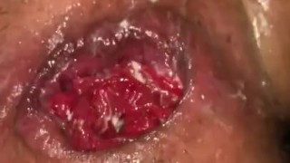 Anal Fisting And Prolapse TEASER