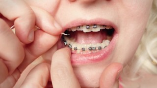 My 2nd day in braces: cleaning by dental floss