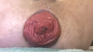 Prolapse Progress