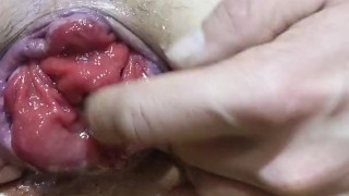 I like to pump my Anal prolapse