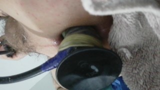 Anal Inflable Extremo Prolapso