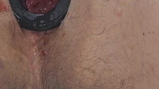 Dilatador anal 2 pulgadas