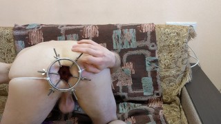 Anal dilation with 6 rode anal dilator